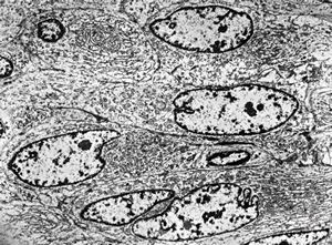 F,61y. | leiomyosarcoma - axilla